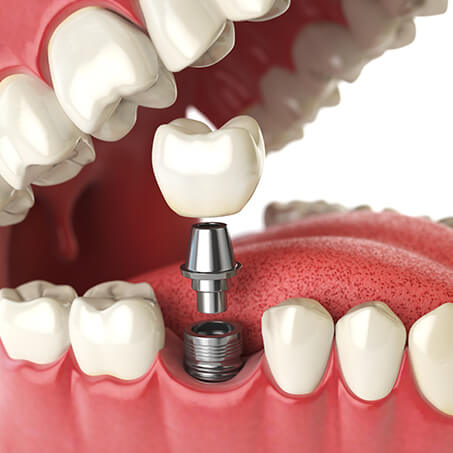 Tooth Replacement Using Dental Implants