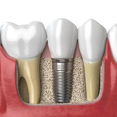 Single Tooth Replacement With Dental Implants