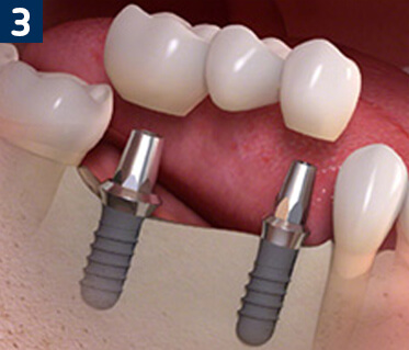 Multiple Tooth Replacement With Dental Implants