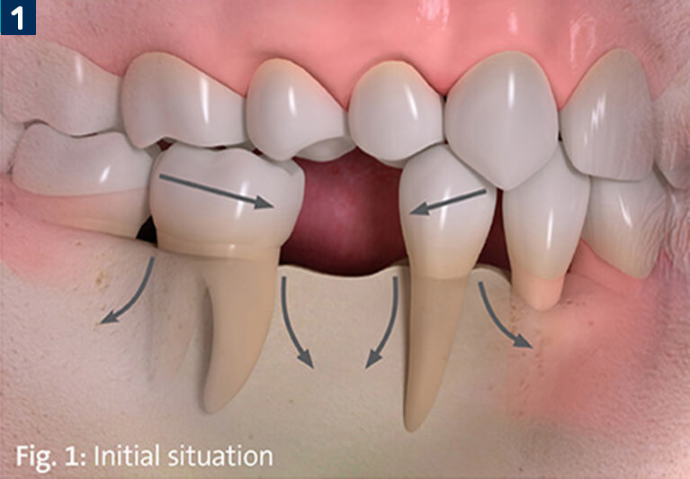 Proper Jaw Bone Denisty