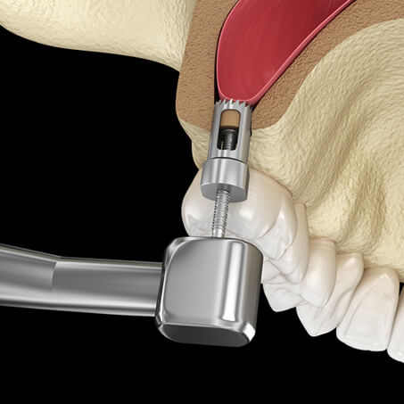 Sinus Lift Surgery