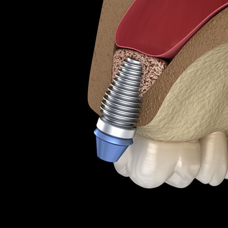 Sinus Lift Treatment