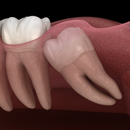 Impacted Wisdom Teeth