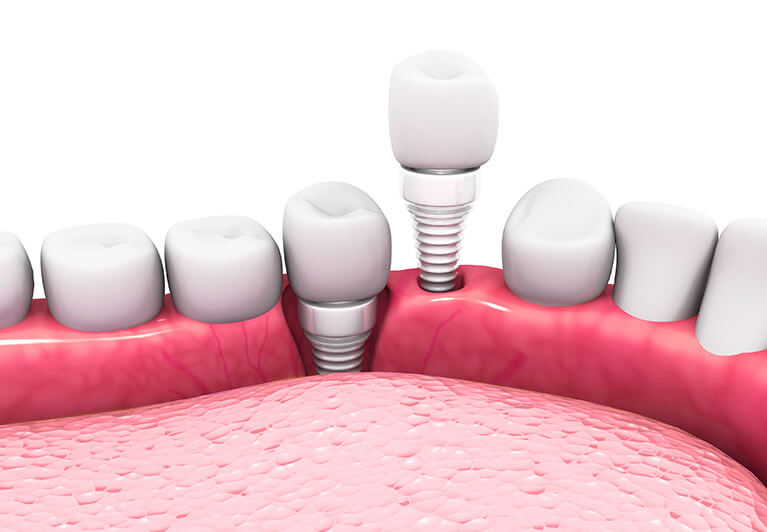 Ceramic Dental Implants