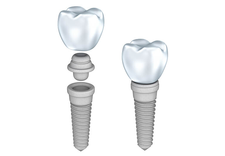 Zirconia Implants