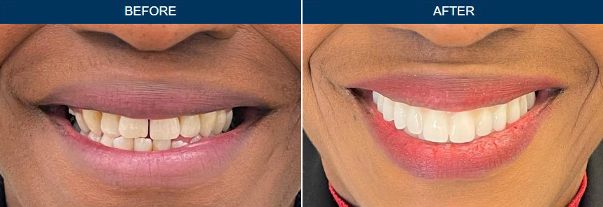 Before & After