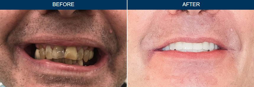 Before & After