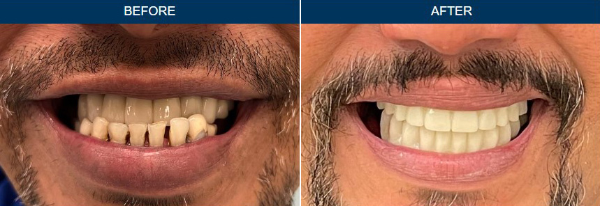 Before & After